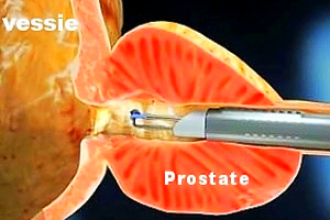 تبخير-البروستات-بالبلازما