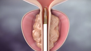 ريزيوم : علاج البروستات بالبخار المضغوط